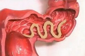 Behandlung von Würmern