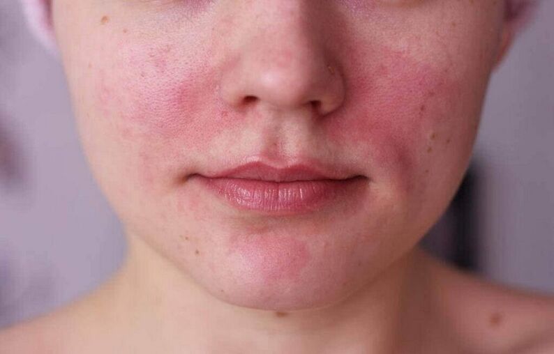 Hautprobleme als Zeichen für das Vorhandensein von Parasiten im Körper